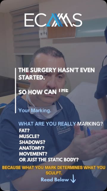 The cannula isn’t the first tool you use in liposculpture.

Your eyes are.

And before the first inc