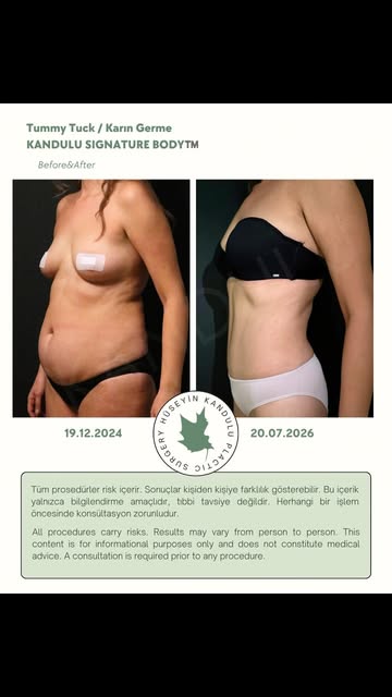 Two years after lipoabdominoplasty — natural definition, firm contours, and lasting stability. 
#kan