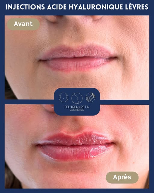 Un résultat subtil, tout en harmonie. 💋✨

L’objectif ici : redessiner délicatement les lèvres, appo