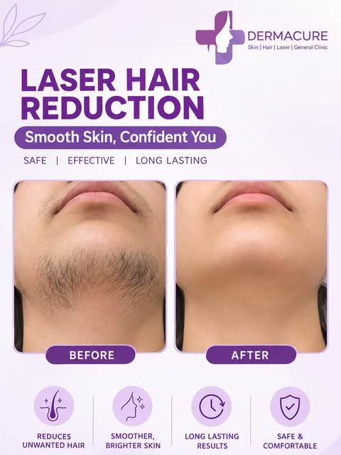 #ʟᴀsᴇʀʜᴀɪʀʀᴇᴅᴜᴄᴛɪᴏɴ #laserskincare #smoothskingoals #skincareroutine #dermacureclinic