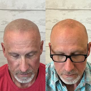 Faded Hairline. Natural and Soft Finish. Takes (3) Sessions of SMP. With Creative Scalps / Bishop Sh