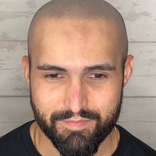 Client from New Mexico. Flew out for (3) sessions of Scalp Micro Pigmentation with John Douglas in o