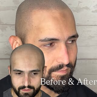 Before & After 3 sessions Of SMP. DM or Call for Details #smp #scalp #bald #scalpmicropigmentation