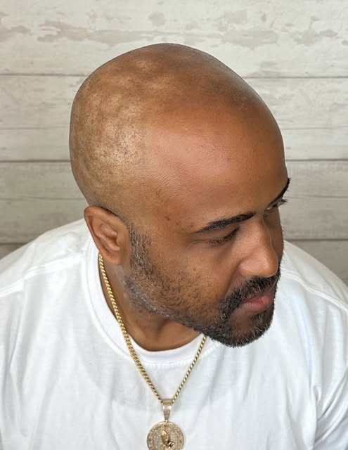 SMP camouflage. Completely transformed our client with (3) sessions of scalp micro pigmentation. Bis