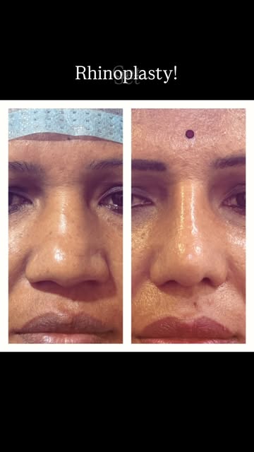 Rhinoplasty at @aesthetica.veda !

Natural! Minimalistic! Custom tailored!

Talk to us to know more.