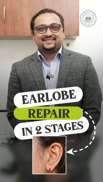 Torn or stretched earlobe? 👂 Here’s why earlobe repair is usually done in two stages.

Earlobe repa