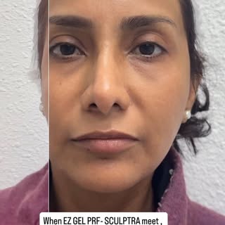 ✨ Why they work better together:
 •  PRF = immediate skin quality + healing boost
 •  Sculptra = lon