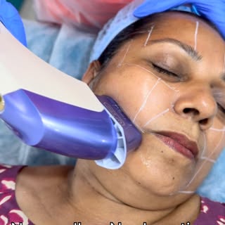 Best face-slimming and face-lift treatment in town! 
#faceslimming #facelift #facecontouring #rejuve