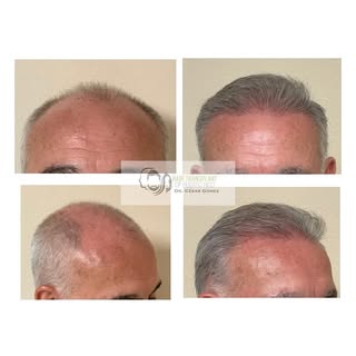 Con la planificación y el diseño adecuado, incluso pacientes con una pérdida de cabello extensa pued