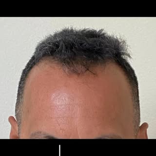 Conoce la historia de Martín... Se benefició de 2,214 injertos para reconstruir su hairline y aument