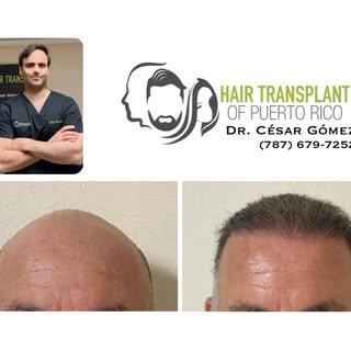 ✅ En Hair Transplant of Puerto Rico, los casos de pérdida de cabello avanzada también pueden lograr 
