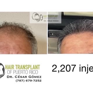 💡 La cantidad de injertos importa, pero lo que realmente marca la diferencia es implantarlos con la