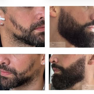 Trasplante de barba:

Para lograr una barba completa o mejorar áreas con poco crecimiento, el traspl