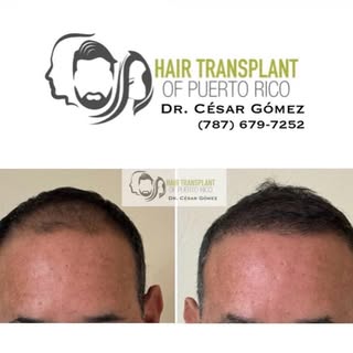 Para recuperar cabello en un área donde se perdió, existe el trasplante de cabello. Para lograr un h