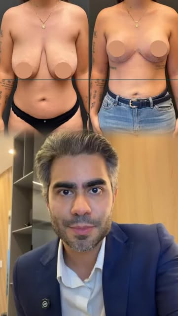 30 kg a menos e uma nova proporção corporal. ✨

Mastoplastia redutora + prótese após grande emagreci