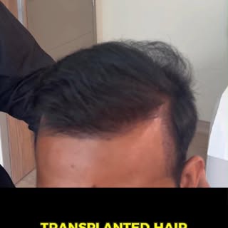 Long hair FUT post-op review.
.
.
.
.
.
#drsajjadkhan #hairtransplantdoctor #hairtransplantdubai #ha