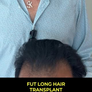 With a need for over 4,000 grafts, the client wisely chose the Long Hair FUT procedure for optimal r
