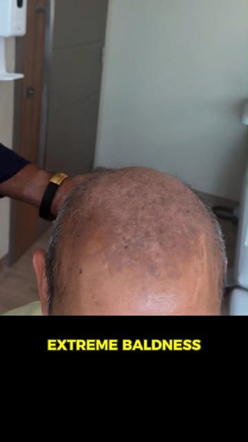 Planning to perform a hair transplant for extensive baldness (class 7) with a limited donor area.
.
