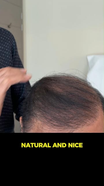 We are assisting a former client who underwent a hair transplant 20 years ago. He has a beautiful ha