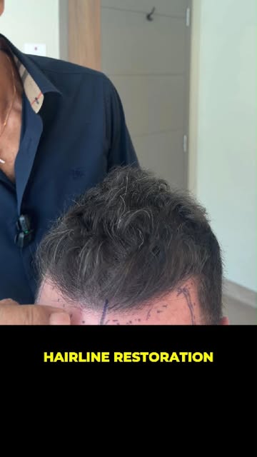 Working with a challenging client who has undergone eight hair transplants elsewhere and is not sati