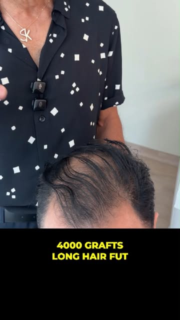After a long discussion, the client decided to proceed with 4,000 long-hair FUT grafts.
.
.
.
.
.
#h
