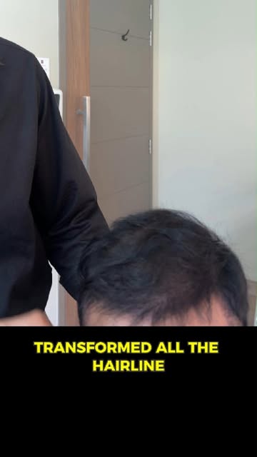 One-day post 4,100 graft Long-Hair FUT update.
.
.
.
.
.
#hairexpert #hairdoctor #drsajjadkhan #Hair