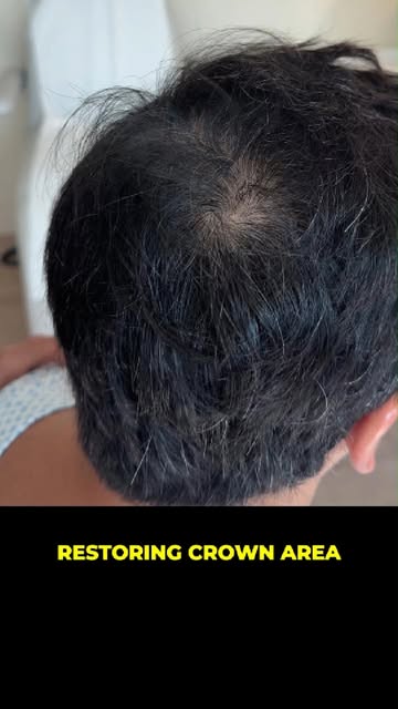 Helping our previous client who had one hair transplant 8 years ago, now restoring the crown area wi