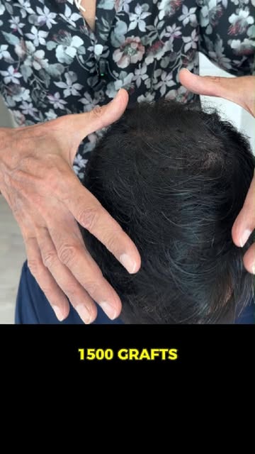 Restored the crown area with 1501 long-hair FUE grafts.
.
.
.
.
#drsajjadkhan #HairRestorationDubai 