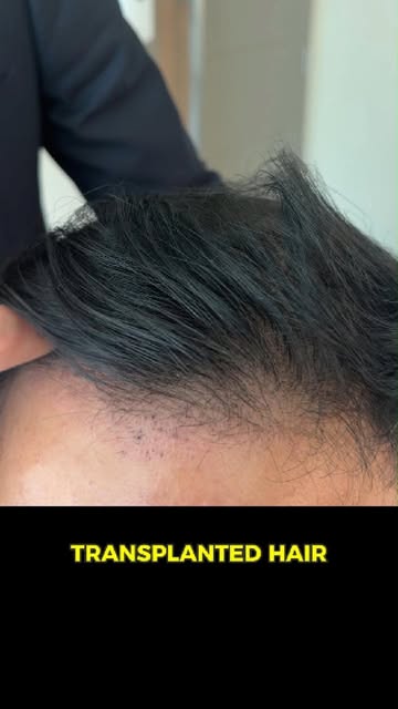Two months after the hair transplant, there is no redness, no signs of surgery, and recovery has bee
