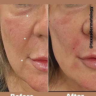 Filler injection, if done properly, can be comparable to a facelift with less risks. 

Look at the J