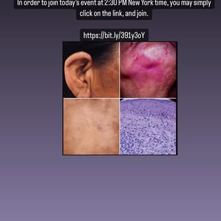 https://bit.ly/3GTiLiT

#dermatology Ground round on a case with a rash. 
https://bit.ly/3GTiLiT

@d