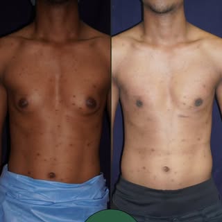Gynaecomastia is one of the leading problem today's youngsters face. It not only cause aesthetic iss