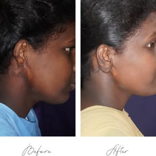 Ear reconstruction 😍

This young girl had an infection in infancy and lost part of her ear. 
She wa