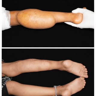Lymphatic Malformation excision . A type of vascular Malformation. 

This young girl had a swelling 