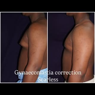 Gynaecomastia correction keeping the liposuction incision and the excision incision in the invisible