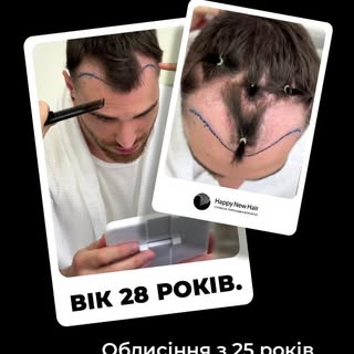 Пацієнт 28 років.
Облисіння турбує з 25ти

Зроблено пересадку волосся методом FUE DHI
Рання стадія о