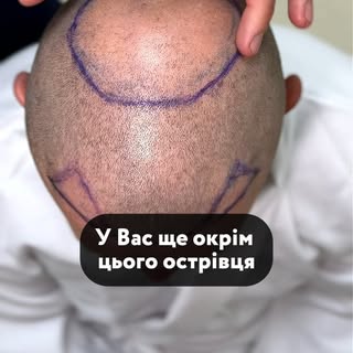 Пересадка волосся в Ужгороді

Так зване "Озеро надії", через яке комплексує багато чоловіків

Дивіть