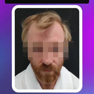Сучасна пересадка волосся в клініці "HappyNewHair"
📍
Висилайте фото для попередньої оцінки на Teleg