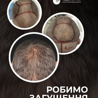 Анатомія густоти: як досягти максимального об'єму волосся.

Загущення (повторна пересадка для збільш