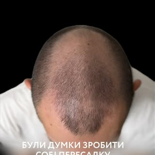 З чого починаються зміни: історія однієї пересадки волосся
 
Наш пацієнт зіткнувся з облисінням ще у