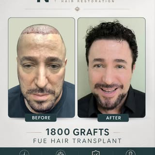 At NEHR, every treatment plan is personalized based on:⁠
• pattern of hair loss⁠
• donor availabilit