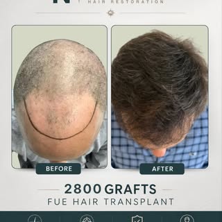 At NEHR, every treatment plan is personalized based on:⁠
• pattern of hair loss⁠
• donor availabilit