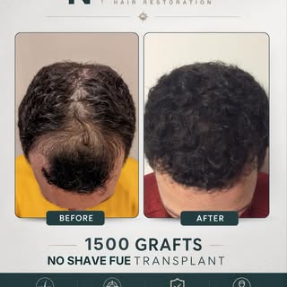 At NEHR, every treatment plan is personalized based on:⁠
• pattern of hair loss⁠
• donor availabilit