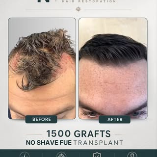 At NEHR, every treatment plan is personalized based on:⁠
• pattern of hair loss⁠
• donor availabilit