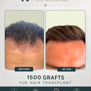 Unlike traditional methods, FUE allows us to extract individual follicles from the donor area using 