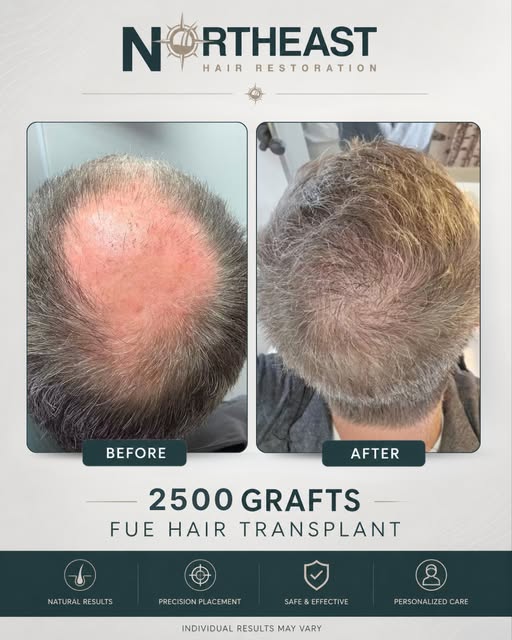 After a thorough consultation to evaluate this patient’s hair loss, donor area, goals, and candidacy