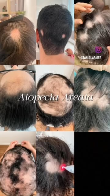 SETEMBRO | MÊS DE CONSCIENTIZAÇÃO DA ALOPECIA AREATA

Uma falha no cabelo pode parecer apenas uma al