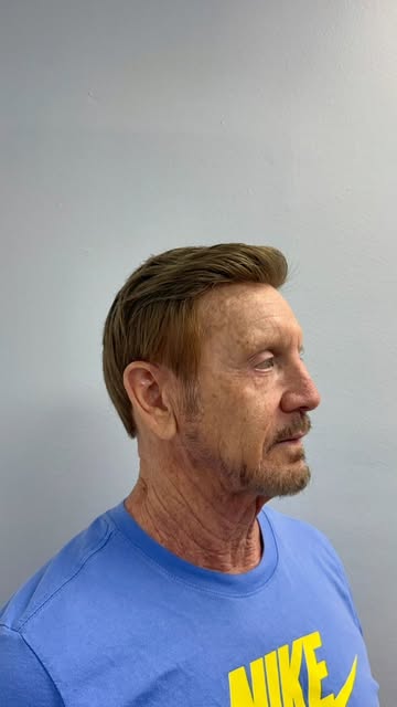 Hair loss doesn’t have to define how you see yourself. ⁠
⁠
This before & after transformation is a r