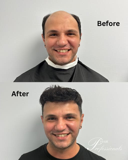 A transformation that’s all about the details. ✨⁠
⁠
This before & after features a custom hair syste
