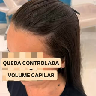 Queda de cabelo? Quem nunca? 
Mas a boa notícia é que com a anamnese certa, direcionada, bem conduzi